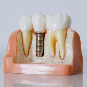 Exploring the Various Types of Dental Implants in Yorba Linda