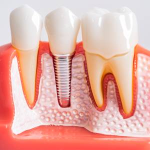 Top 5 Signs You May Need Dental Implants in Yorba Linda